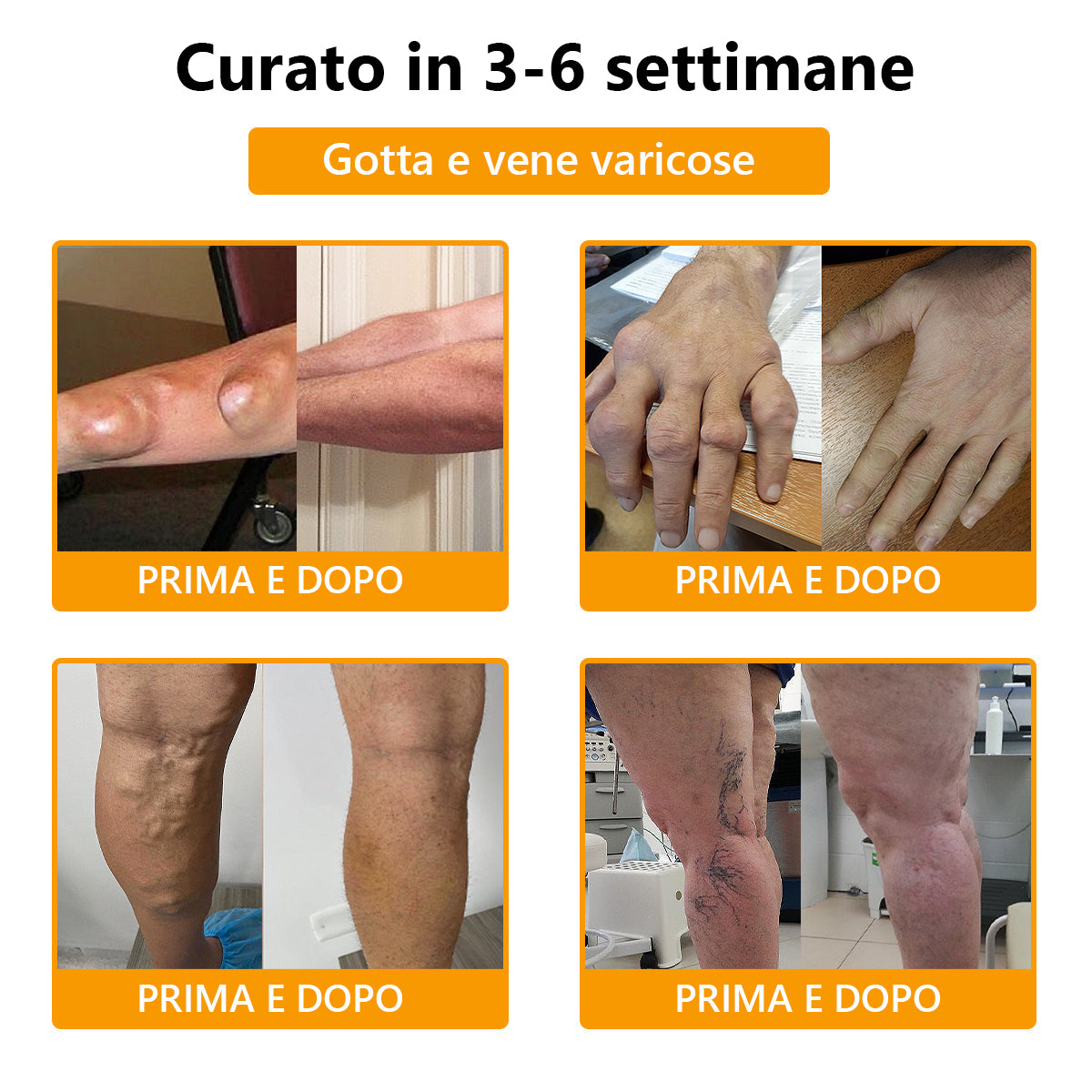 💥Aeehfeng™💥 Crema per il trattamento dell'artrite con veleno d'api e curcuma—specializzata in condizioni ortopediche e dolori articolari 🐝🐝